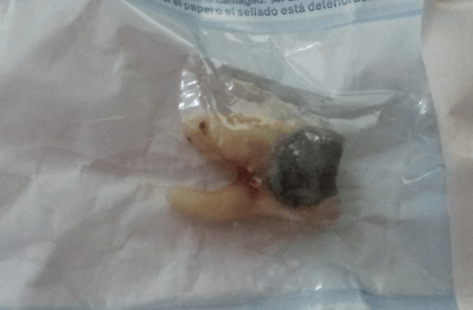 Molar Tooth with filling